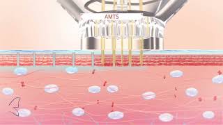 Introducing EPN Plus Microneedling with Electroporation [upl. by Stets]