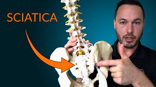 Understanding Sciatica Everything you need to know about the causes and treatment of sciatica [upl. by Bonnie245]