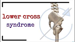 Lower Cross Syndrome and Innominate Rotation [upl. by Ayortal]