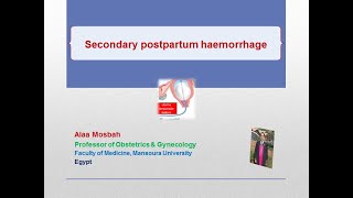 Secondary postpartum haemorrhage [upl. by Ecniv]