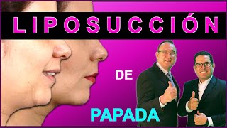 LIPOPAPADA  LIPECTOMIA SUBMENTAL CERVICOPLASTIA LIPOSUCCIÓN DE PAPADA [upl. by Suirauqram470]