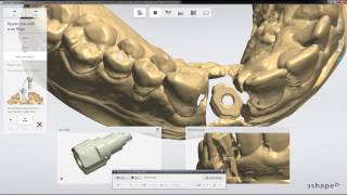 Digital Implant Scanning Workflow in 3Shape [upl. by Borden]