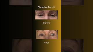 Fibroblast  Eye Lift  fibroblast plasmapen orangecounty [upl. by Huda]