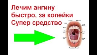 Лучшее и безопасное средство от ангины 100 [upl. by Underwood]