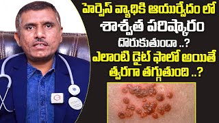 హెర్పెస్ వ్యాధికి శాశ్వత పరిష్కారం Dr Ramana Raju About Permanent Solution For Herpes Disease [upl. by Amelita]