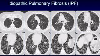 CHEST 2016 video sessions HRCT of the chest [upl. by Vidovik]