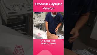 External Cephalic Version for baby breech presentation shorts obstetrics birth cesareanbirth [upl. by Japha892]