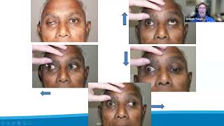 Doctor I See Doublequot Diagnosing and Managing Patients with Neurogenic Diplopia [upl. by Yerfej]