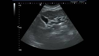 Advanced LC with splenomegaly [upl. by Arhas]