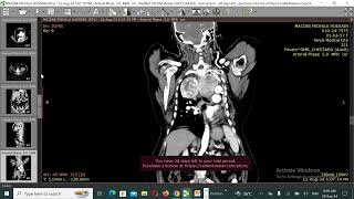 Carcinoid tumor of the lung [upl. by Ecitnirp]