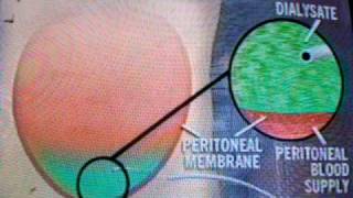 Continuous Ambulatory Peritoneal Dialysis [upl. by Nnaeirrac]