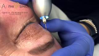 PhiIon technique upper eyelid lifting treatment [upl. by Earehc]