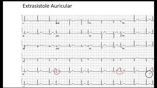 Extrasistole Auricular EKG [upl. by Oric]