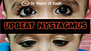 How To Examine A Patient With Nystagmus  Upbeat Nystagmus [upl. by Ddat156]