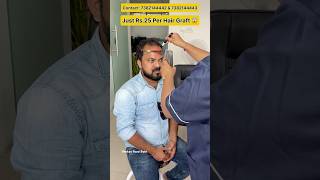 Hair Transplant Just ₹25 Per Graft at SJM Clinics Hyderabad shorts ytshorts hairtransplant [upl. by Danya]