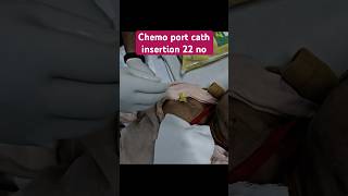 Chemo port cath insertion 22 no [upl. by Trebo]