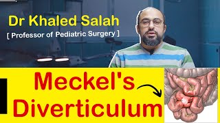 Meckels diverticulum medical students and pediatric surgeons [upl. by Odravde]