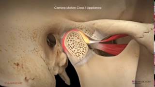 Carriere® Motion Clear™ Appliance with Clear Aligners Patient Education Animation [upl. by Cummine802]