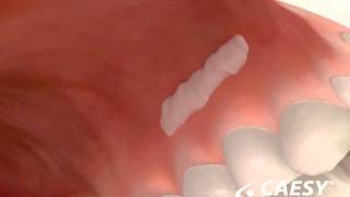 Periodontal Disease Surgery Free Gingival Graft [upl. by Natam]