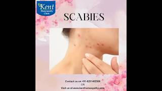 scabies Best homeopathy treatment Drkukreja kalani online consult 8291492566 [upl. by Marje231]