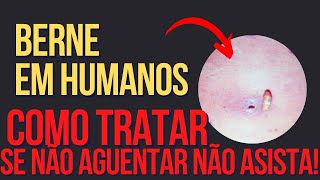 Berne em humanos o que é principais sintomas e tratamento berne furunclo pus secreção [upl. by Durand]