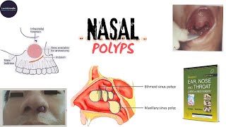 NASAL POLYPANTROCHOANALETHMOIDALETIOLOGYSSTREATMENT dhingra otorhinolaryngology udaipurwala [upl. by Aihsiek]