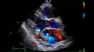 経胸壁心エコー図 急性僧帽弁逆流症 MR 2 左室長軸像カラードプラ [upl. by Gall]