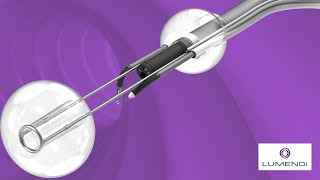 DiLumen C2 with flexible endoscopic grasper and colonic ESD procedures [upl. by Genie194]