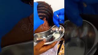 Bouchon de cérumenbain d’oreilleextractionwax removal [upl. by Boiney]