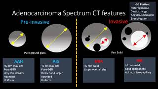 Adenocarcinoma Spectrum [upl. by Sundberg]