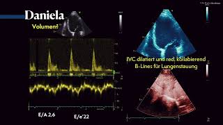 Diastolische Dysfunktion PWDoppler amp Volumenstatus im Ultraschall 〖Ultraschall〗 💘💫 [upl. by Arondell]