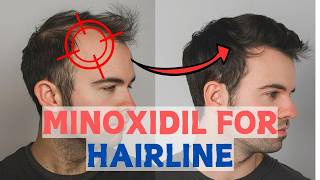 Minoxidil for Frontal Baldness  Restore Your Hairline [upl. by Ateval]