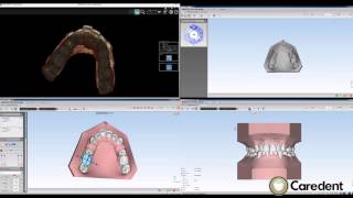 CS CAD Ortho uses of Carestream CS3500 Intraoral scanner [upl. by Erialc]