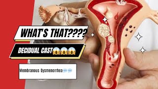 Decidual Cast  Period  flesh in your period menses women periods [upl. by Zeuqcaj]