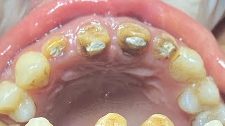 REMOVING AND TOOTH AND THEN PUTTING IT BACK [upl. by Ingrid]