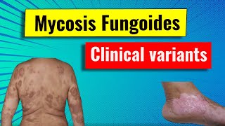 Clinical variants of Mycosis fungoides MF [upl. by Anert]