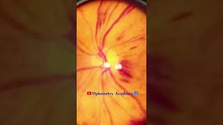 Diabetic retinopathy  Hemorrhages  proliferative diabetic retinopathy PDR  Short Video 184 [upl. by Seana]