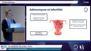 Adénomyose et infertilité — Dr M Bourdon [upl. by Aigroeg570]