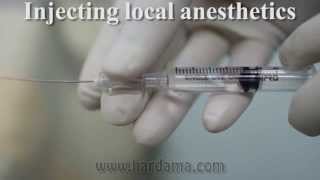 Spinal anesthesia [upl. by Aititil]