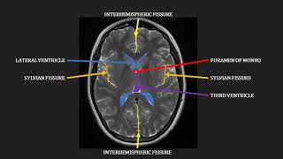 Introduction to MRI of the brain [upl. by Anilos]