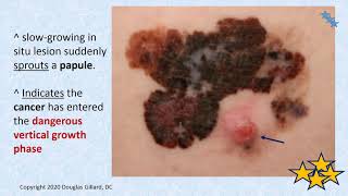 Malignant Melanoma The Most Deadly Form of Skin Cancer Primary Health Care Providers Cant Miss It [upl. by Islehc]