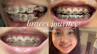 Braces Overbite Time lapse with extractions [upl. by Aenil454]