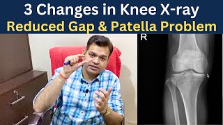 Knee x ray Knee Osteoarthritis Gap Reduced Chondromalacia patella Knee Joint Degeneration [upl. by Traci]