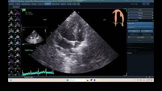 IQ 315 AUTOEF PYOMETRA ECHOPAC ANALYSIS ECHOCARDIOGRAPHY [upl. by Andryc]