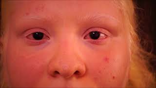 Life of an albino with and without albinism contact lens at INDIA [upl. by Singer]