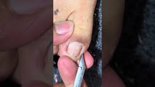 Satisfying Toe Cleaning  Relaxing Foot Care amp Deep Clean ASMR 32 [upl. by Thayer]