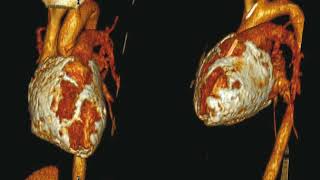 Rheumatic Heart Disease روماتيزم القلب [upl. by Aillicsirp]