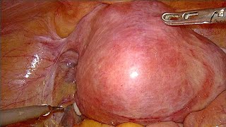 Large fibroid uterus TLH unedited [upl. by Aliahkim]