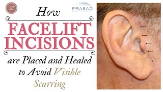 How Visible Facelift Incision Scars are Avoided Treated and Healed [upl. by Tikna]