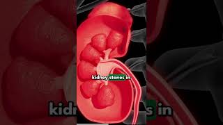 🍵 Can TEA Cause KIDNEY STONES Understand the Risk 🌿 kidneystones health shorts [upl. by Lozar]